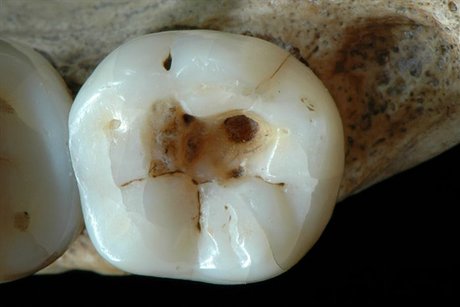 تاریخ 14 هزار ساله دندانپزشکی